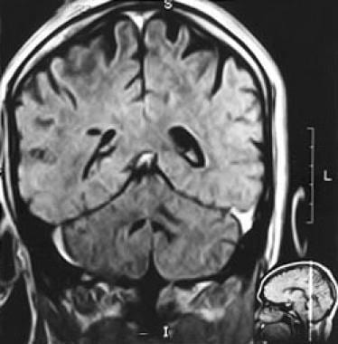 Case 3: MRI of a 47-year-old man with 2 right pari