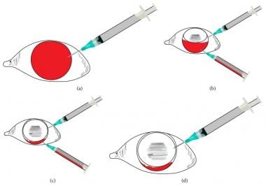 Air-fluid exchange two-needle technique: (a) Entry