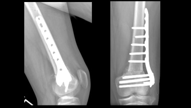 Growth plate (physeal) fractures. Corrective osteo
