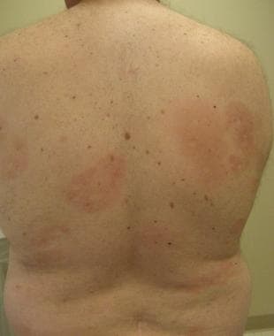 Pityriasis alba