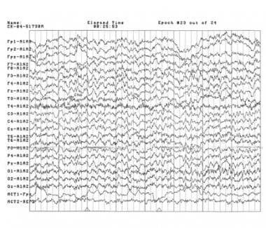 A page of an electroencephalogram of an 8-year-old