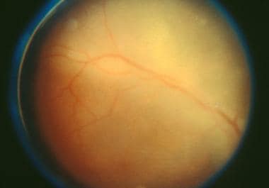 Retinal vasculitis in a patient with ocular syphil