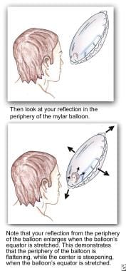 Reflection in the periphery of the balloon. 