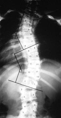 Mixed vertebral deformity involving the thoracolum