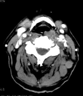 Hypopharyngeal Cancer: Overview, Clinical Presentation, Etiology and ...