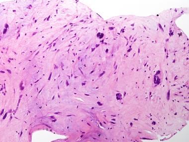 High magnification of stromal tumor of uncertain m