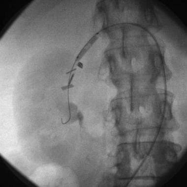 Fluoroscopic image shows inflated percutaneous tra