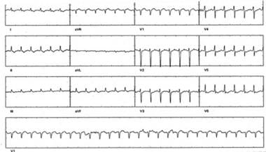 Supraventricular tachycardia (SVT) in a patient wi