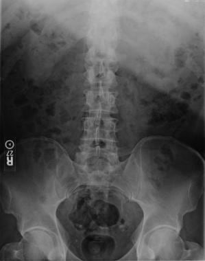 Excretory urography imaging sequence: A plain KUB 
