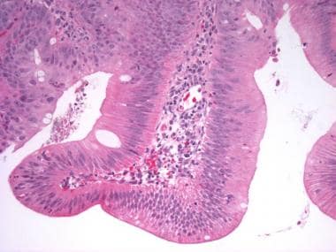 This is an example of low-grade glandular dysplasi