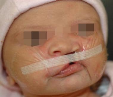 A child with unilateral cleft lip and palate being