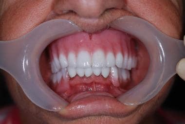 Maxillary complete denture used to restore the upp