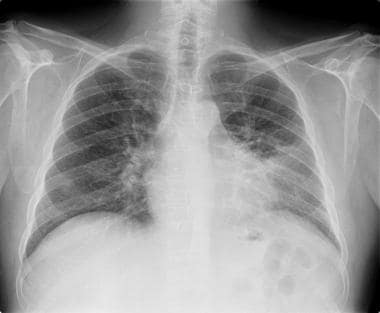 Coccidioidomycosis Imaging: Overview, Radiography, CT Scan