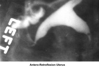 Infertility. Antero-retroflexion uterus. Image cou