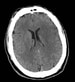 Middle Cerebral Artery Stroke