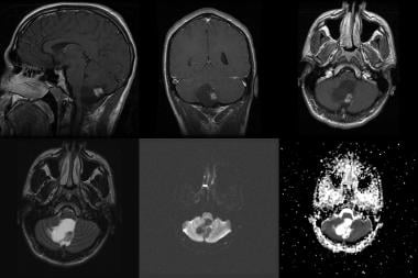Pilocytic astrocytoma in a 20-year-old man. Top ro