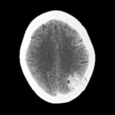 Large right frontal and left occipital cavernous a