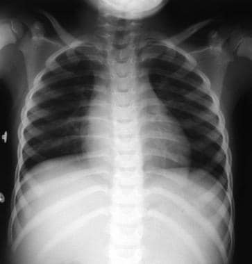 This frontal chest radiograph shows a right parasp