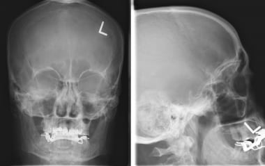 Frontal skull radiograph illustrates a calcified m