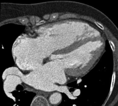 Contrast-enhanced CT demonstrating an atrial septa