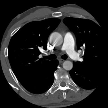 Computed tomography angiography in a young man who