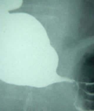Detail of a barium swallow study demonstrating the