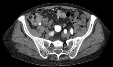 Incidental finding in an 87-year-old man undergoin