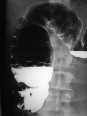 Benign cystic pneumatosis. Radiograph from a bariu