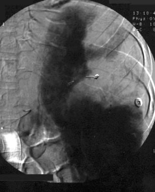 Spleen, trauma. Angiogram obtained after supersele