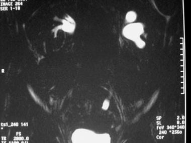 Dilated collecting system on left seen on MRI 