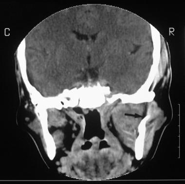 Coronal 5-mm CT cut through the anterior cranial f