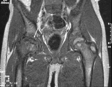 Coronal T1-weighted MRI in a 12-year-old boy with 