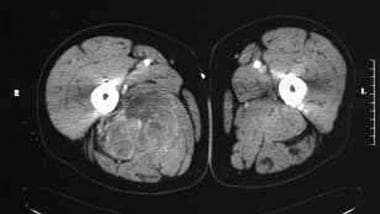Transverse CT image following enhancement with int