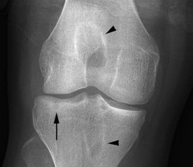 Anteroposterior radiograph of the knee 1 year afte