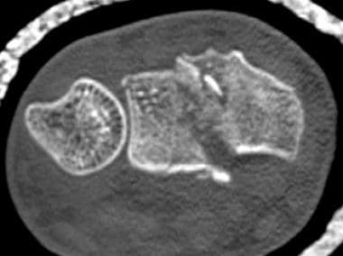 Axial computed tomography (CT) scan demonstrates a
