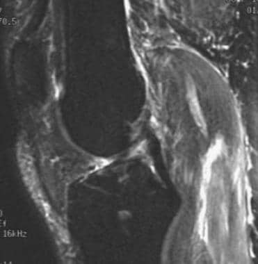 Chronic tear of the ACL, false-negative result on 