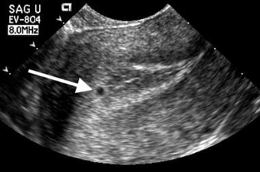 Embryonic demise. This very small sac (arrow) is p