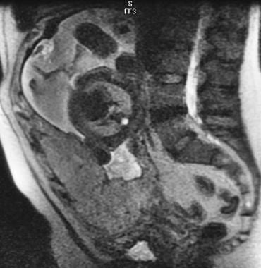 Sagittal T2-weighted image (SSFSE) depicts a compl