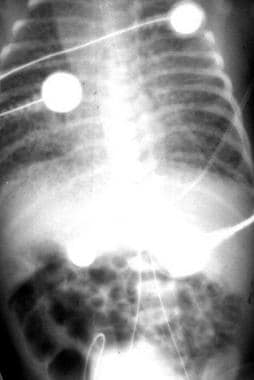 Chest and abdominal radiograph in a neonate with a