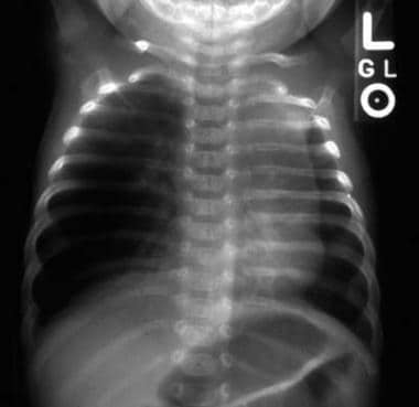 Anteroposterior chest radiograph shows overexpansi