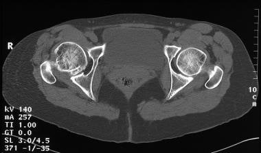 Legg-Calvé-Perthes disease. Axial nonenhanced CT s