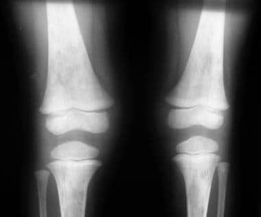 Anteroposterior (AP) views of both knees show irre