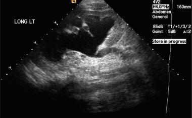 Renal sonogram in a patient with high-grade vesico