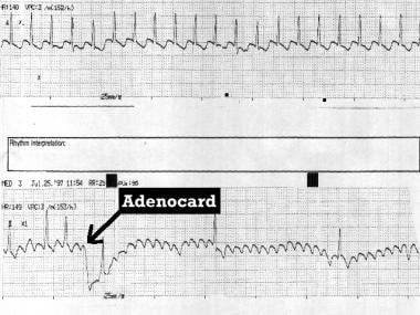 Type I atrial flutter unmasked by adenosine (Adeno