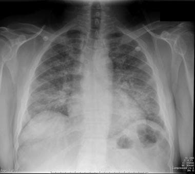 Chest radiograph demonstrating diffuse bilateral i