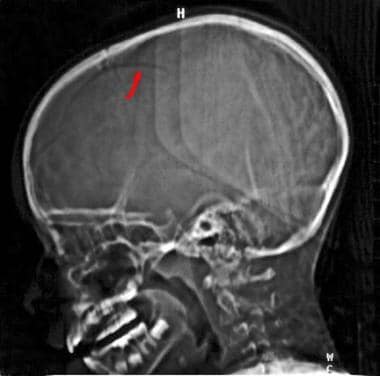 Skull fracture - Emergency neuroradiology. Lateral