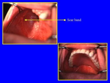 Scar band formed by the muco-dermal junction helps
