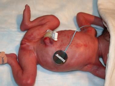 Fungal Infections in Preterm Infants. Congenital c