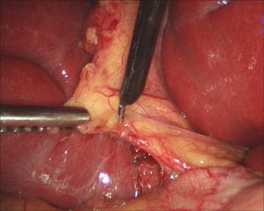 Laparoscopic cholecystectomy. Use of L-hook electr