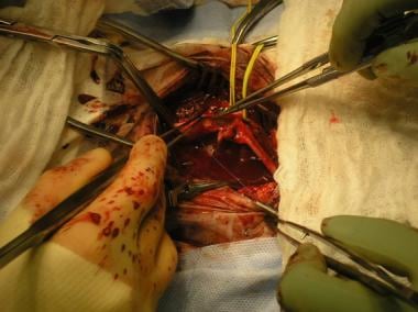 Back wall of anastomosis is completed with continu